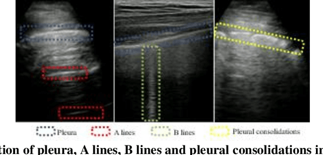 Figure 1 for covEcho Resource constrained lung ultrasound image analysis tool for faster triaging and active learning