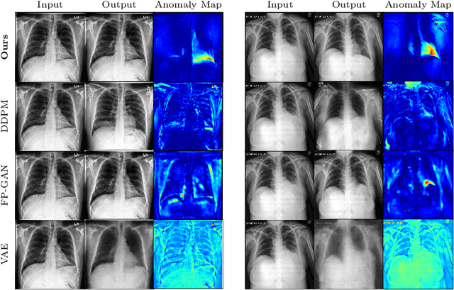 Figure 3 for Diffusion Models for Medical Anomaly Detection