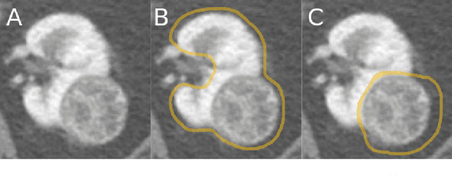 Figure 1 for The KiTS19 Challenge Data: 300 Kidney Tumor Cases with Clinical Context, CT Semantic Segmentations, and Surgical Outcomes