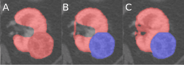 Figure 2 for The KiTS19 Challenge Data: 300 Kidney Tumor Cases with Clinical Context, CT Semantic Segmentations, and Surgical Outcomes