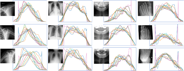 Figure 4 for Projectron -- A Shallow and Interpretable Network for Classifying Medical Images