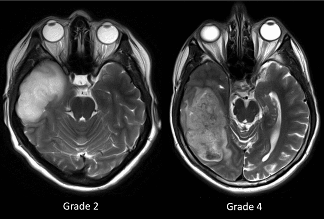 Figure 3 for Machine Learning Based Radiomics for Glial Tumor Classification and Comparison with Volumetric Analysis