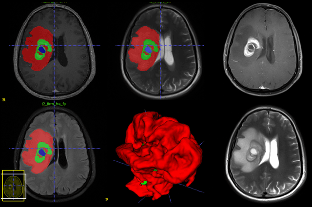 Figure 2 for Machine Learning Based Radiomics for Glial Tumor Classification and Comparison with Volumetric Analysis