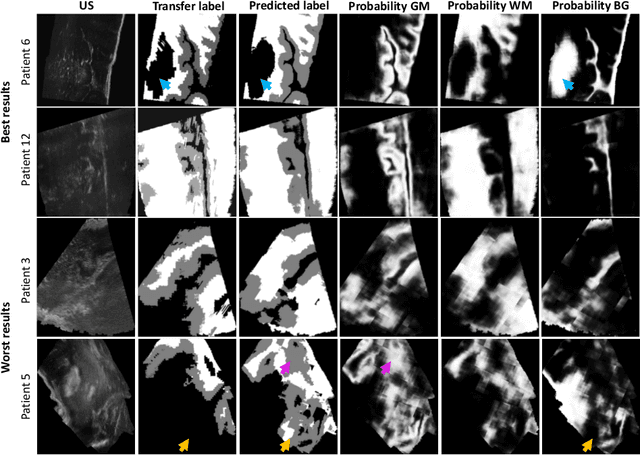 Figure 3 for Weakly-Supervised White and Grey Matter Segmentation in 3D Brain Ultrasound