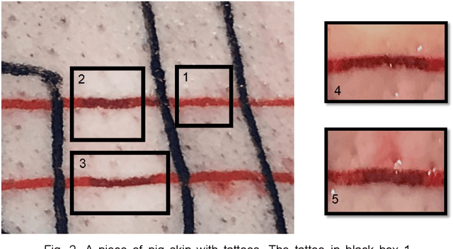 Figure 2 for Photoacoustic-monitored laser treatment for tattoo removal: a feasibility study