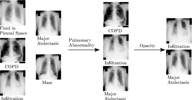 Figure 3 for Deep Hiearchical Multi-Label Classification Applied to Chest X-Ray Abnormality Taxonomies