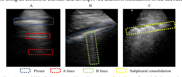 Figure 1 for Unsupervised multi-latent space reinforcement learning framework for video summarization in ultrasound imaging