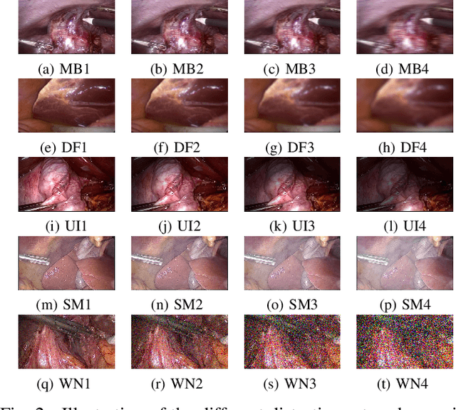 Figure 2 for End-to-End Blind Quality Assessment for Laparoscopic Videos using Neural Networks