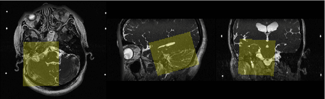 Figure 3 for Unsupervised Domain Adaptation for Vestibular Schwannoma and Cochlea Segmentation via Semi-supervised Learning and Label Fusion