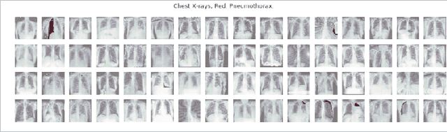 Figure 4 for Pneumothorax Segmentation: Deep Learning Image Segmentation to predict Pneumothorax