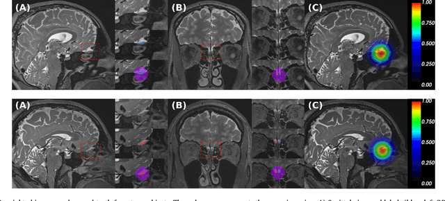 Figure 1 for Automated Olfactory Bulb Segmentation on High Resolutional T2-Weighted MRI