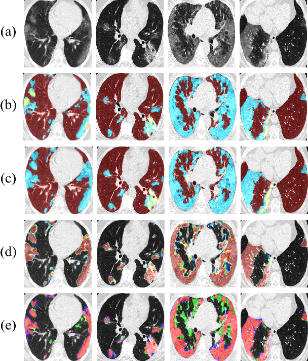 Figure 3 for A Deep Ensemble Learning Approach to Lung CT Segmentation for COVID-19 Severity Assessment