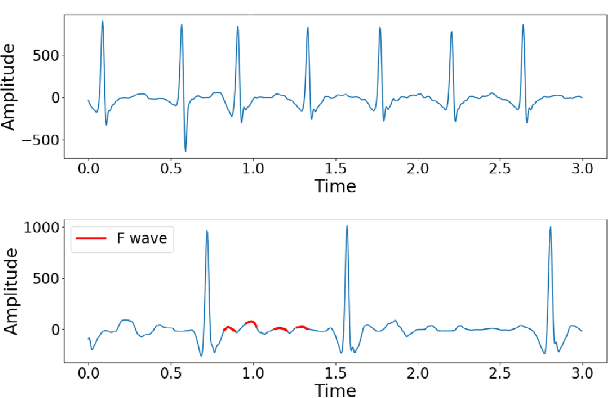 Figure 2 for Electrocardiogram Classification and Visual Diagnosis of Atrial Fibrillation with DenseECG