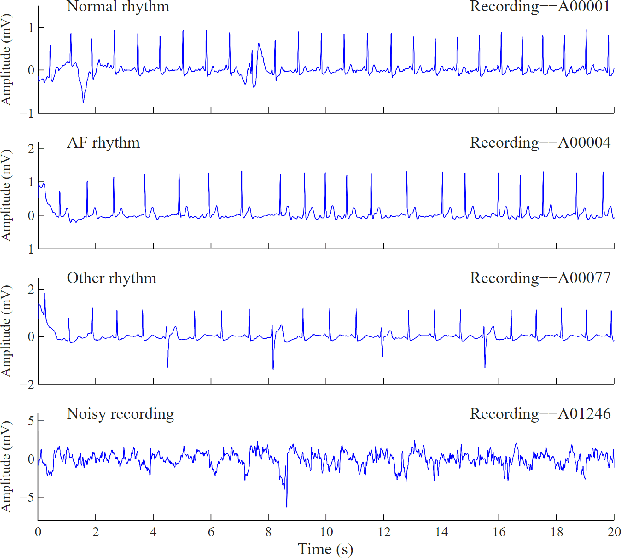 Figure 3 for Electrocardiogram Classification and Visual Diagnosis of Atrial Fibrillation with DenseECG