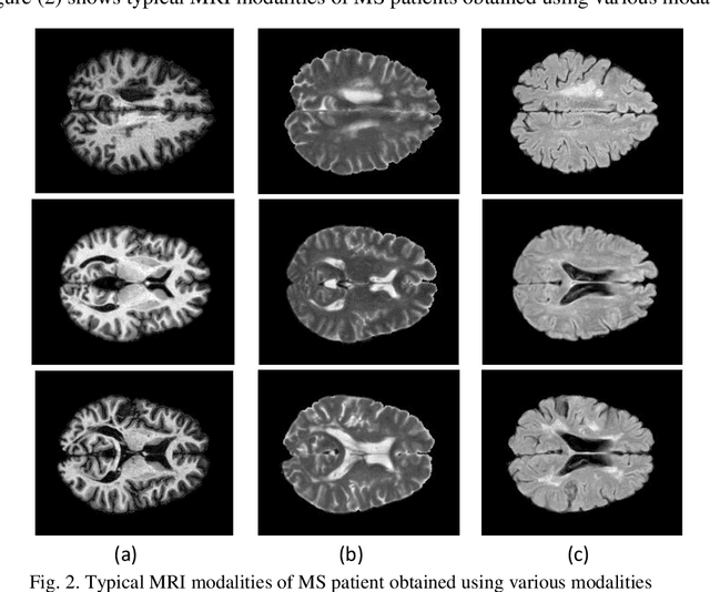 Figure 3 for Applications of Deep Learning Techniques for Automated Multiple Sclerosis Detection Using Magnetic Resonance Imaging: A Review