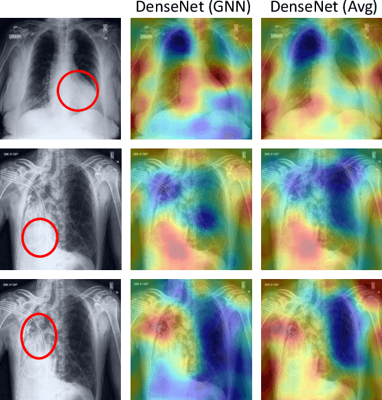 Figure 4 for Learning Decision Ensemble using a Graph Neural Network for Comorbidity Aware Chest Radiograph Screening