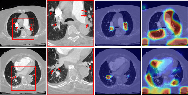 Figure 3 for Automatic Diagnosis of Pulmonary Embolism Using an Attention-guided Framework: A Large-scale Study
