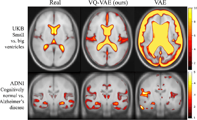 Figure 3 for Morphology-preserving Autoregressive 3D Generative Modelling of the Brain