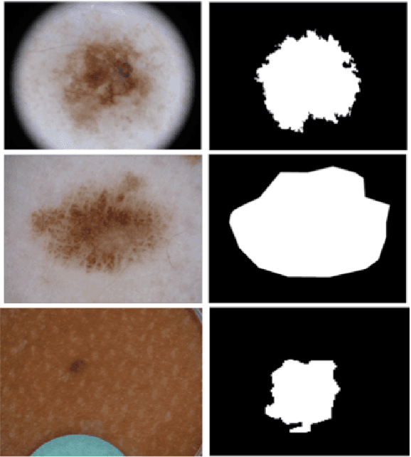 Figure 3 for Handling Inter-Annotator Agreement for Automated Skin Lesion Segmentation