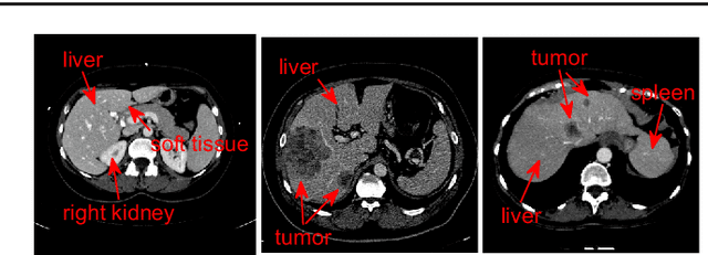 Figure 1 for Automatic 3D liver location and segmentation via convolutional neural networks and graph cut