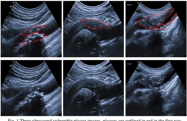 Figure 1 for Parallel Network with Channel Attention and Post-Processing for Carotid Arteries Vulnerable Plaque Segmentation in Ultrasound Images