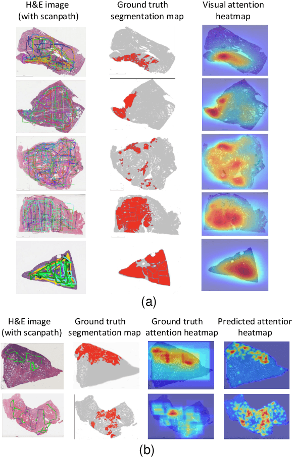 Figure 4 for Visual attention analysis of pathologists examining whole slide images of Prostate cancer
