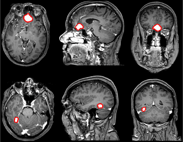 Figure 1 for Fast meningioma segmentation in T1-weighted MRI volumes using a lightweight 3D deep learning architecture