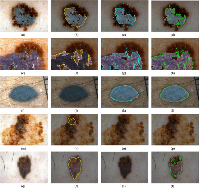 Figure 3 for Learning to Detect Blue-white Structures in Dermoscopy Images with Weak Supervision