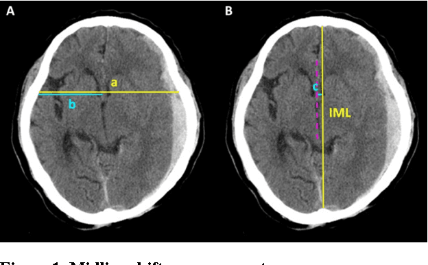Figure 1 for A Simple, Fast and Fully Automated Approach for Midline Shift Measurement on Brain Computed Tomography