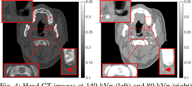 Figure 4 for An Improved Iterative Neural Network for High-Quality Image-Domain Material Decomposition in Dual-Energy CT