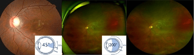 Figure 1 for Bridge the Domain Gap Between Ultra-wide-field and Traditional Fundus Images via Adversarial Domain Adaptation