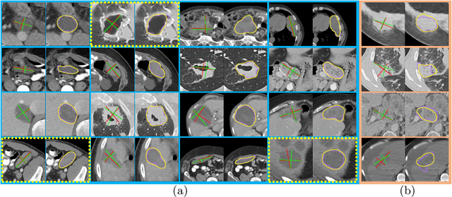 Figure 3 for One Click Lesion RECIST Measurement and Segmentation on CT Scans