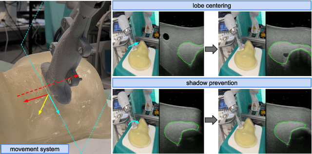 Figure 3 for RSV: Robotic Sonography for Thyroid Volumetry