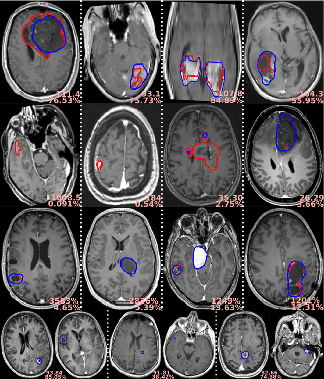 Figure 3 for Preoperative brain tumor imaging: models and software for segmentation and standardized reporting