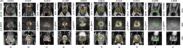 Figure 4 for The impact of using voxel-level segmentation metrics on evaluating multifocal prostate cancer localisation