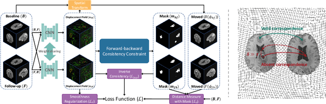 Figure 1 for Unsupervised Deformable Image Registration with Absent Correspondences in Pre-operative and Post-Recurrence Brain Tumor MRI Scans