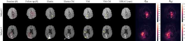 Figure 3 for Unsupervised Deformable Image Registration with Absent Correspondences in Pre-operative and Post-Recurrence Brain Tumor MRI Scans