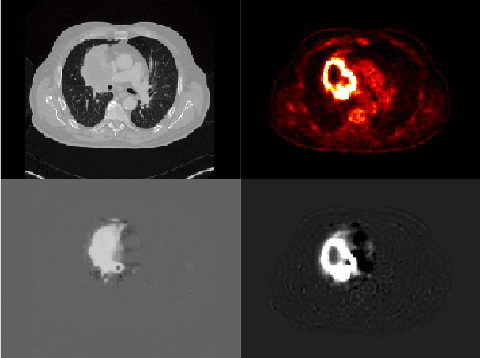 Figure 3 for PriorNet: lesion segmentation in PET-CT including prior tumor appearance information