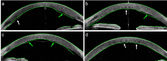 Figure 3 for Corneal Pachymetry by AS-OCT after Descemet's Membrane Endothelial Keratoplasty