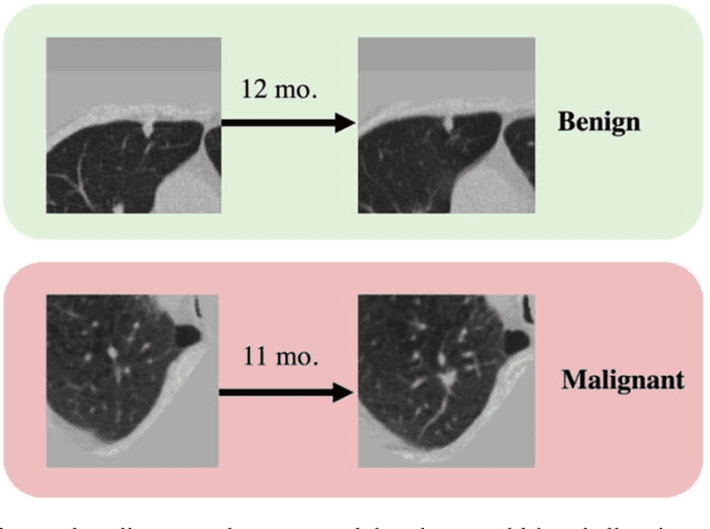 Figure 1 for Time-distance vision transformers in lung cancer diagnosis from longitudinal computed tomography