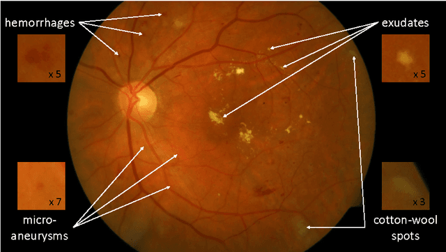 Figure 1 for Deep image mining for diabetic retinopathy screening