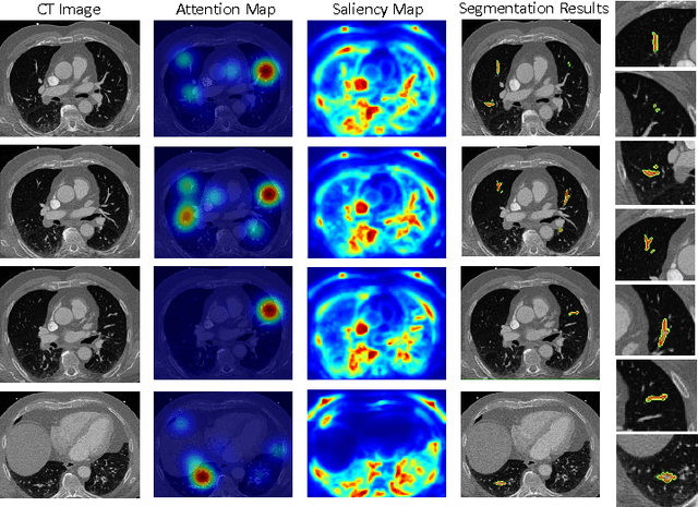 Figure 4 for Gaze2Segment: A Pilot Study for Integrating Eye-Tracking Technology into Medical Image Segmentation