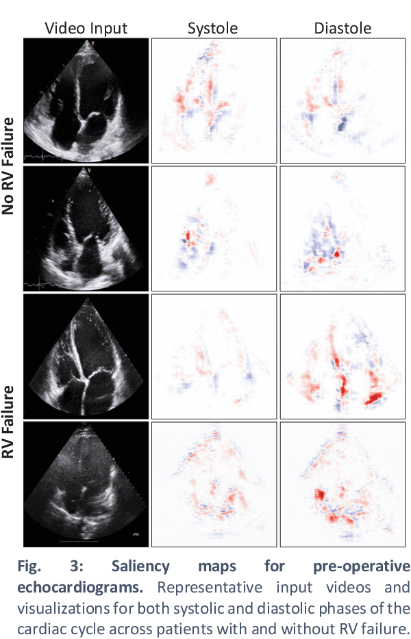Figure 3 for Predicting post-operative right ventricular failure using video-based deep learning