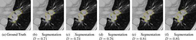 Figure 1 for Radiomic Feature Stability Analysis based on Probabilistic Segmentations