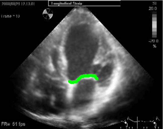 Figure 1 for Using Anatomical Markers for Left Ventricular Segmentation of Long Axis Ultrasound Images
