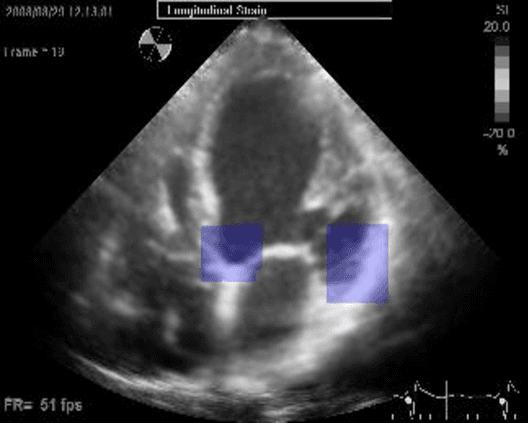 Figure 2 for Using Anatomical Markers for Left Ventricular Segmentation of Long Axis Ultrasound Images