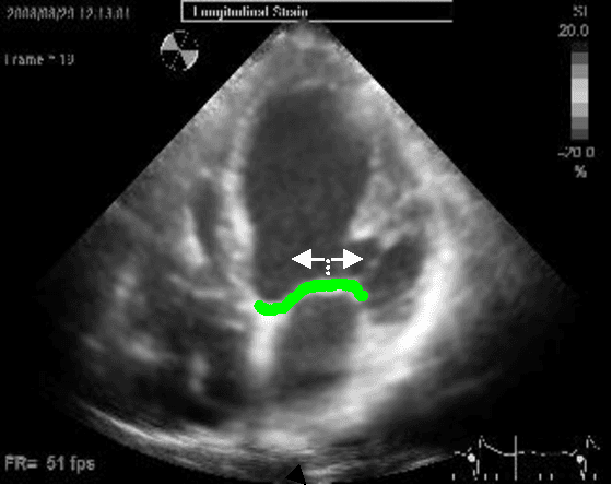 Figure 4 for Using Anatomical Markers for Left Ventricular Segmentation of Long Axis Ultrasound Images