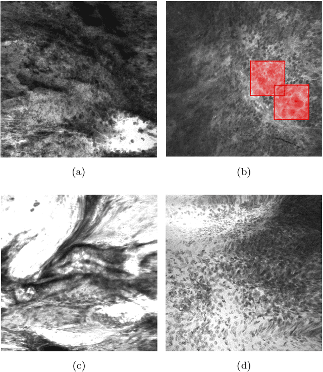 Figure 1 for Convolutional Neural Networks: Ensemble Modeling, Fine-Tuning and Unsupervised Semantic Localization for Intraoperative CLE Images