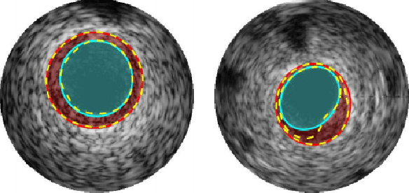 Figure 2 for Shape Detection In 2D Ultrasound Images