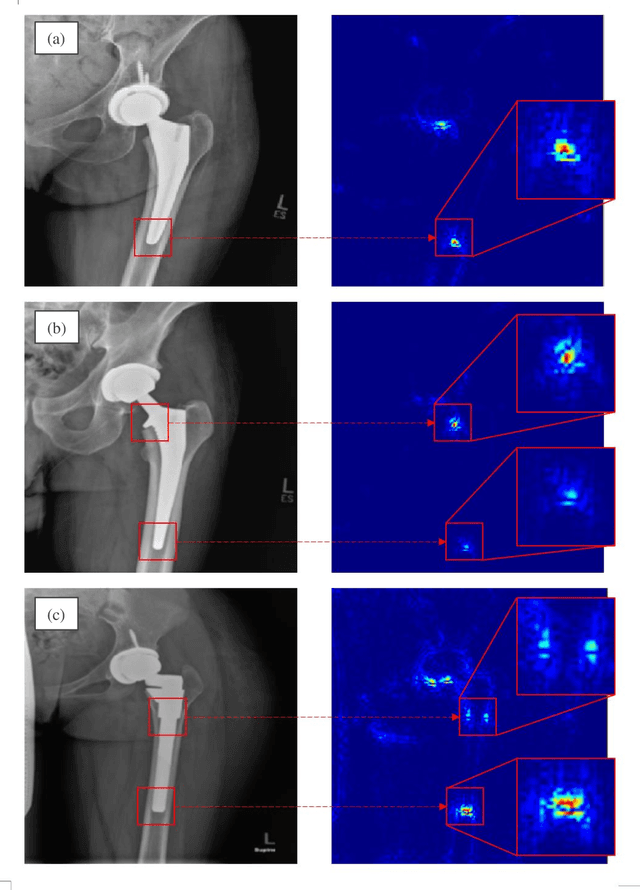 Figure 4 for Detecting total hip replacement prosthesis design on preoperative radiographs using deep convolutional neural network